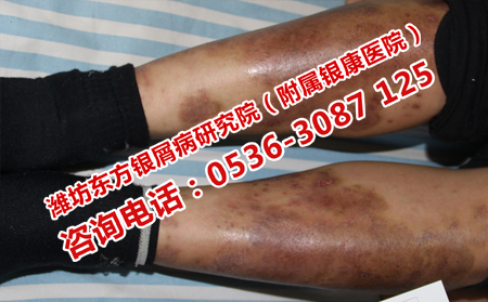 槐荫哪里看扩散的银屑病