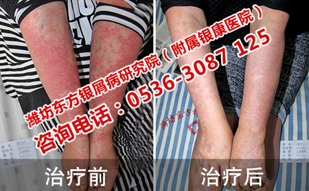 红皮型银屑病治好案例
