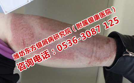 如何应对牛皮癣的复发