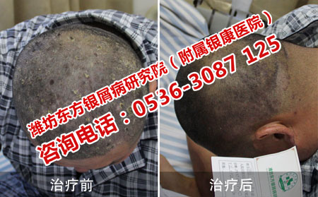 头部牛皮癣治好案例