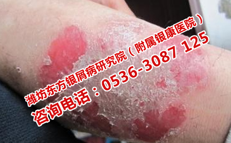 银屑病患者注意的习惯问题