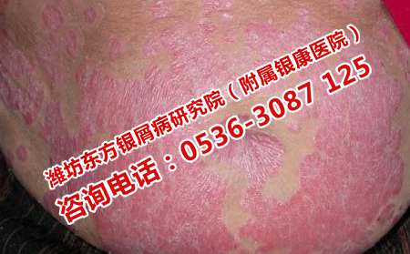 济南那家医院治银屑病行