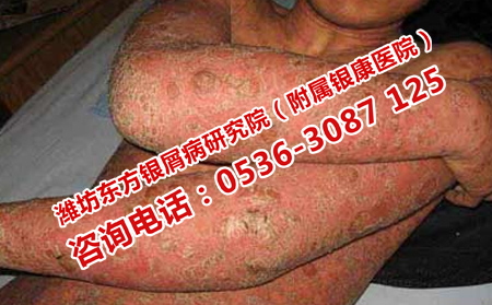 补骨脂治疗牛皮癣