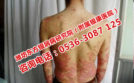 去哪里看银屑病好