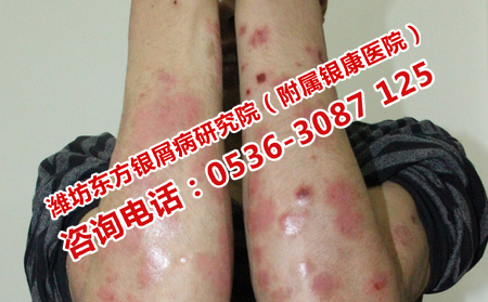 什么医院治银屑病好