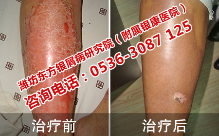 摆脱顽固银屑病的案例