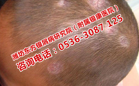 局部银屑病的治疗方法