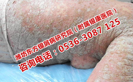 治疗银屑病济南哪家医院专业