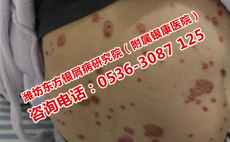 中药治疗银屑病的费用