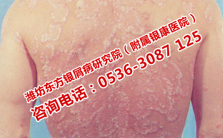 大雪节气银屑病的护理