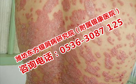 顽固牛皮癣的治疗办法
