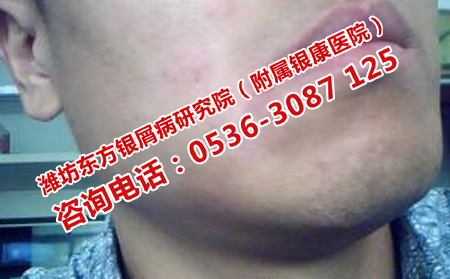 济南银屑病医院医疗报销