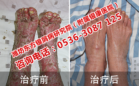 关节型银屑病治好案例