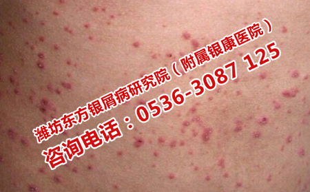 银屑病面积增大怎么治疗
