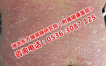 如何让银屑病快点好转
