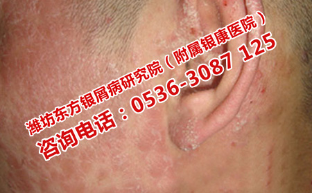 如何摆脱银屑病困扰