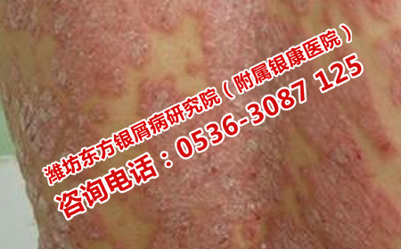 牛皮癣初期能治好吗