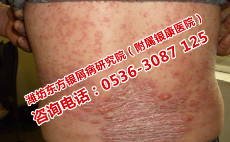 得了银屑病不要灰心
