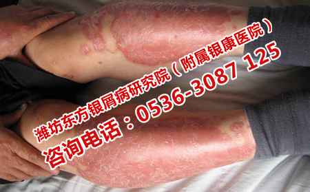 济南银屑病医院治疗