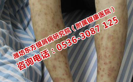 寻常性银屑病治疗费用