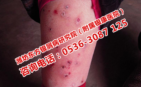 银屑病治好还会复发吗
