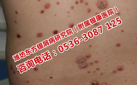 济南治银屑病的费用