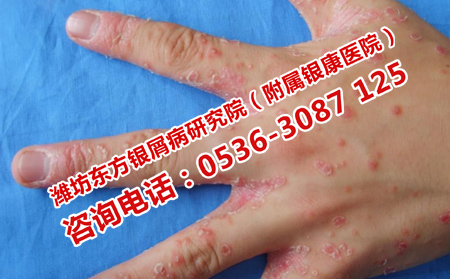 非药物治疗银屑病