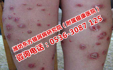 济南迁延难愈的银屑病