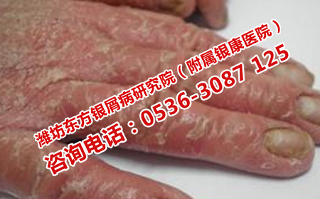 中医治疗脓疱型牛皮癣