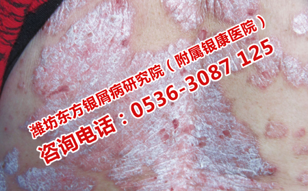 银屑病康复攻略