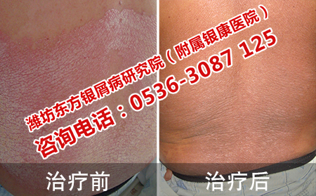 爷爷背部银屑病案例