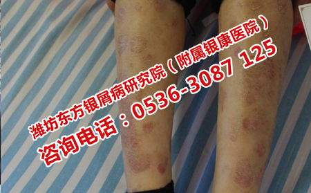 银屑病治不好的真相曝光