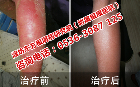 红皮型银屑病治好病例
