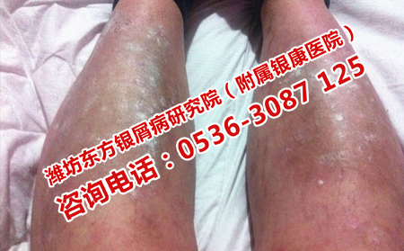 去哪里治平阴银屑病