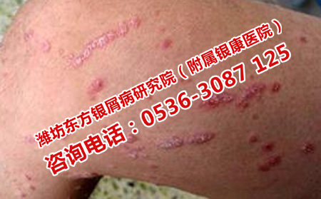 银屑病如何治疗快