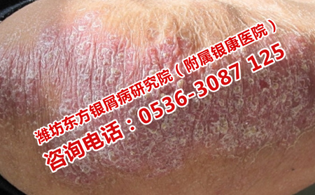 银屑病患者的病情复发的症状是什么