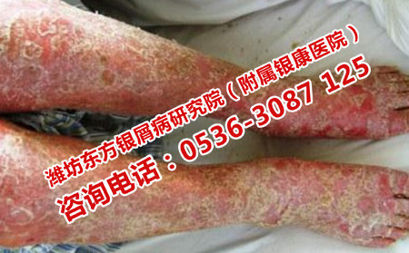 不同类型的银屑病护理