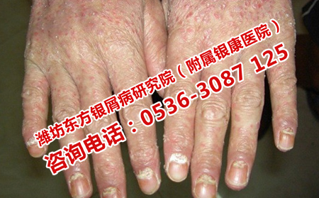 济南哪里看银屑病好
