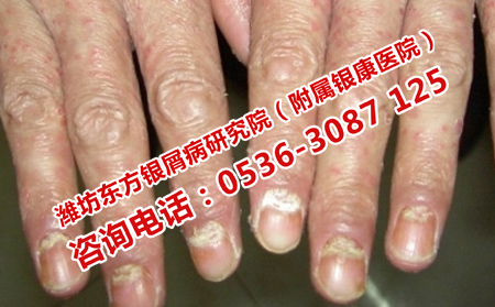 济南银屑病正规的医院