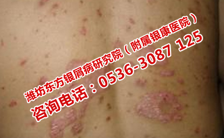 钢城治银屑病好的地方
