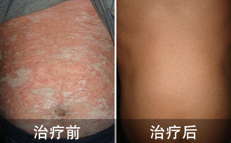 严重顽固的银屑病终于治好了