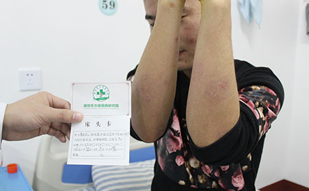 银屑病自愈的案例