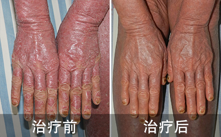 银屑病乱忌口的案例