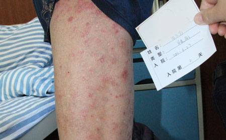 如何才能让银屑病不复发