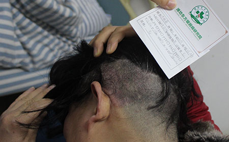 钢城治疗银屑病