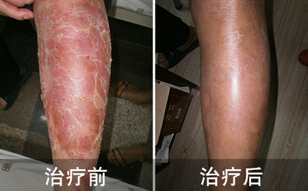 腿部银屑病治好的案例