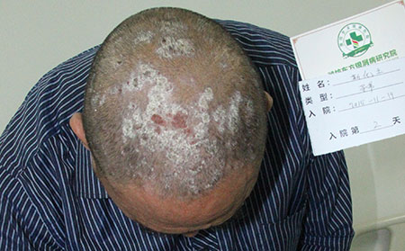 银屑病患者增强免疫的办法