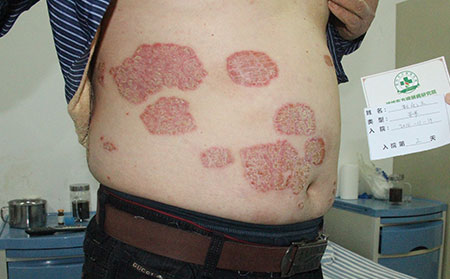 肥胖h会增高银屑病发病风险