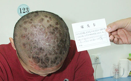 银屑病治疗多少钱