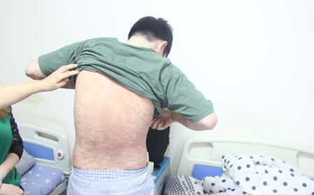 牛皮癣病状